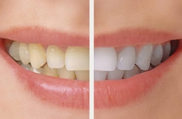 Image of bleaching