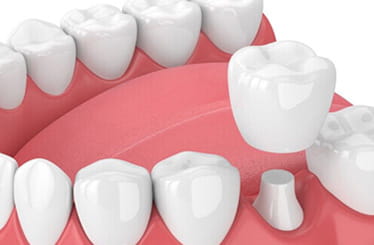 Image of crowns
