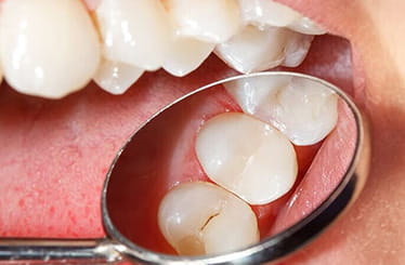 Image of fillings