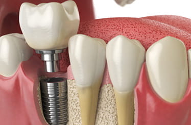 Image of implants