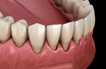 Image of non-surgical gum treatment