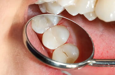 Image of sealants