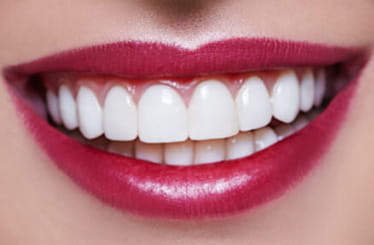 Image of veneers
