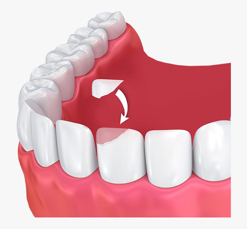 Animated illustration showing the dental bonding process used to repair a chipped tooth.