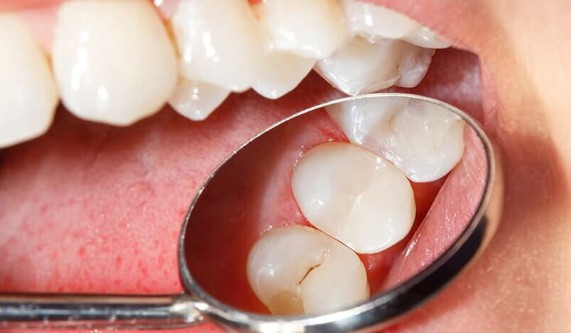 Image of a dentist using a dental mirror to inspect a patient's teeth for cavities.