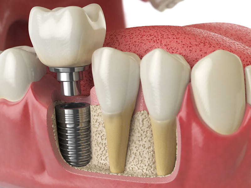 Animated illustration of a dental crown being placed onto a titanium implant post.