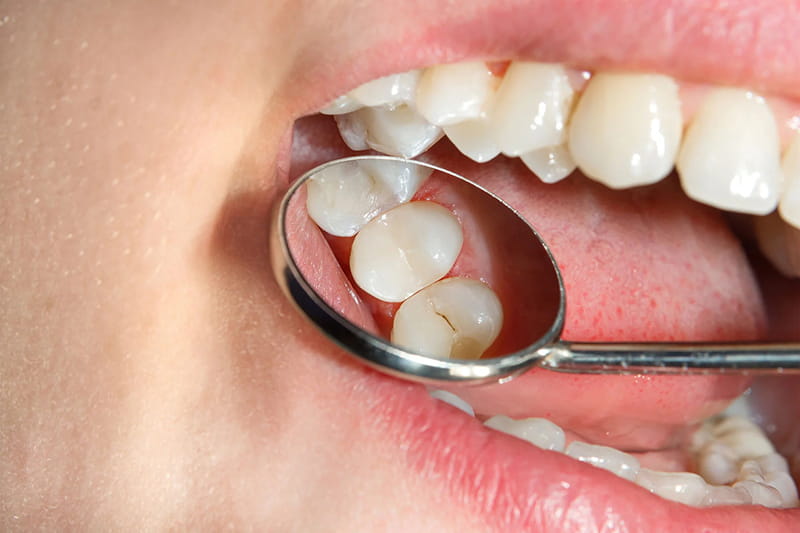 Image of a dental mirror reflecting a patient's molars as a dentist examines the teeth.